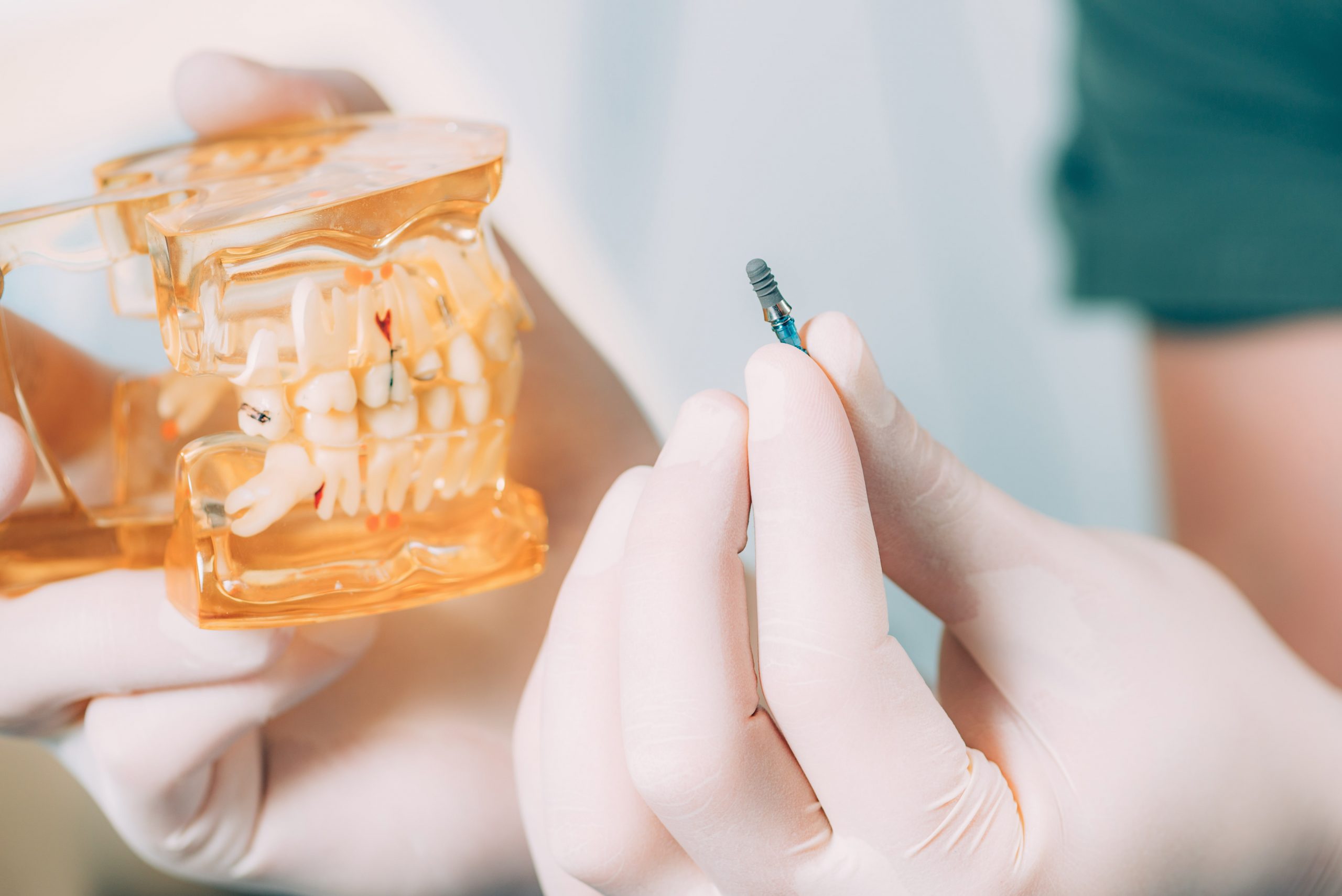 Advantages of Dental Implants in Turkey