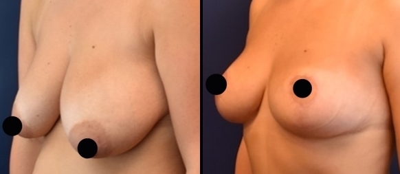 Breast lift surgery