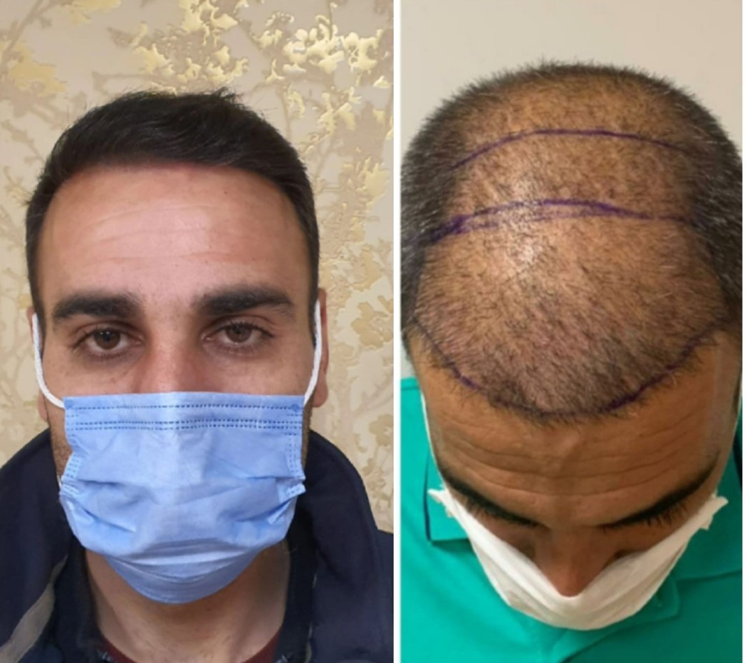 Hair Transplant Before After  7
