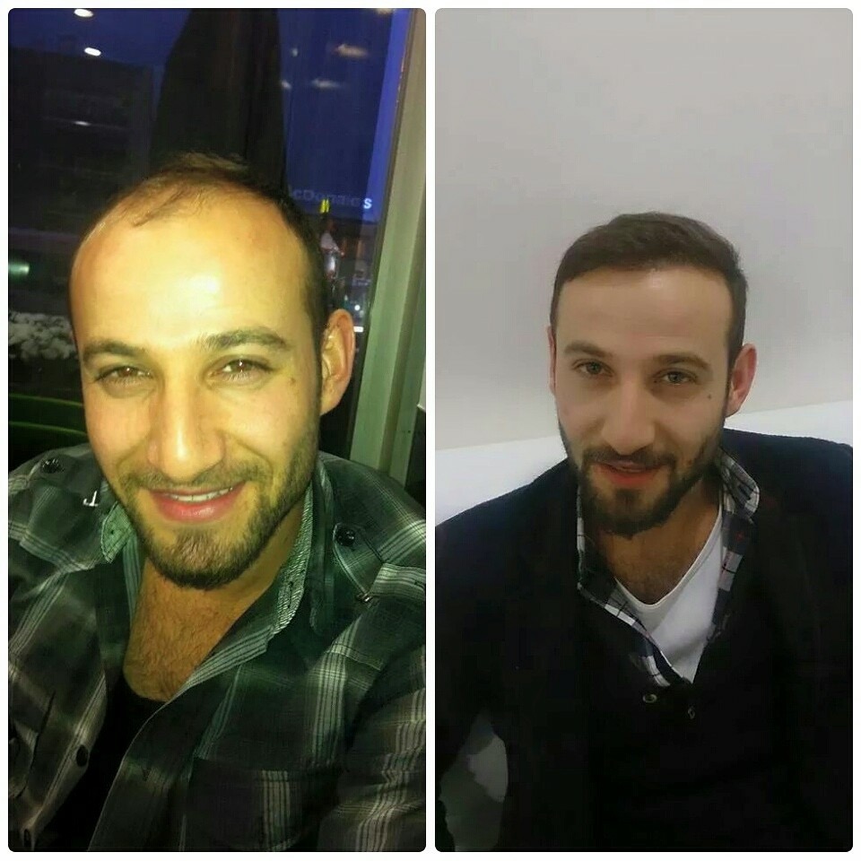 Hair Transplant Before After 6