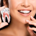 歯のベニアとは何ですか？