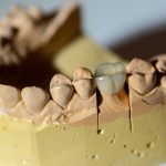 Què són i com funcionen els ponts dentals?