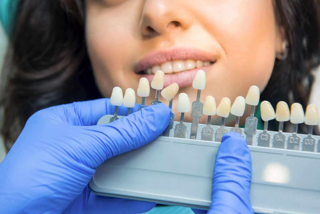How Much is a Full Set of Veneers in Turkey? Veneers Cost 2 tooth color chart 4YGJFF5 min