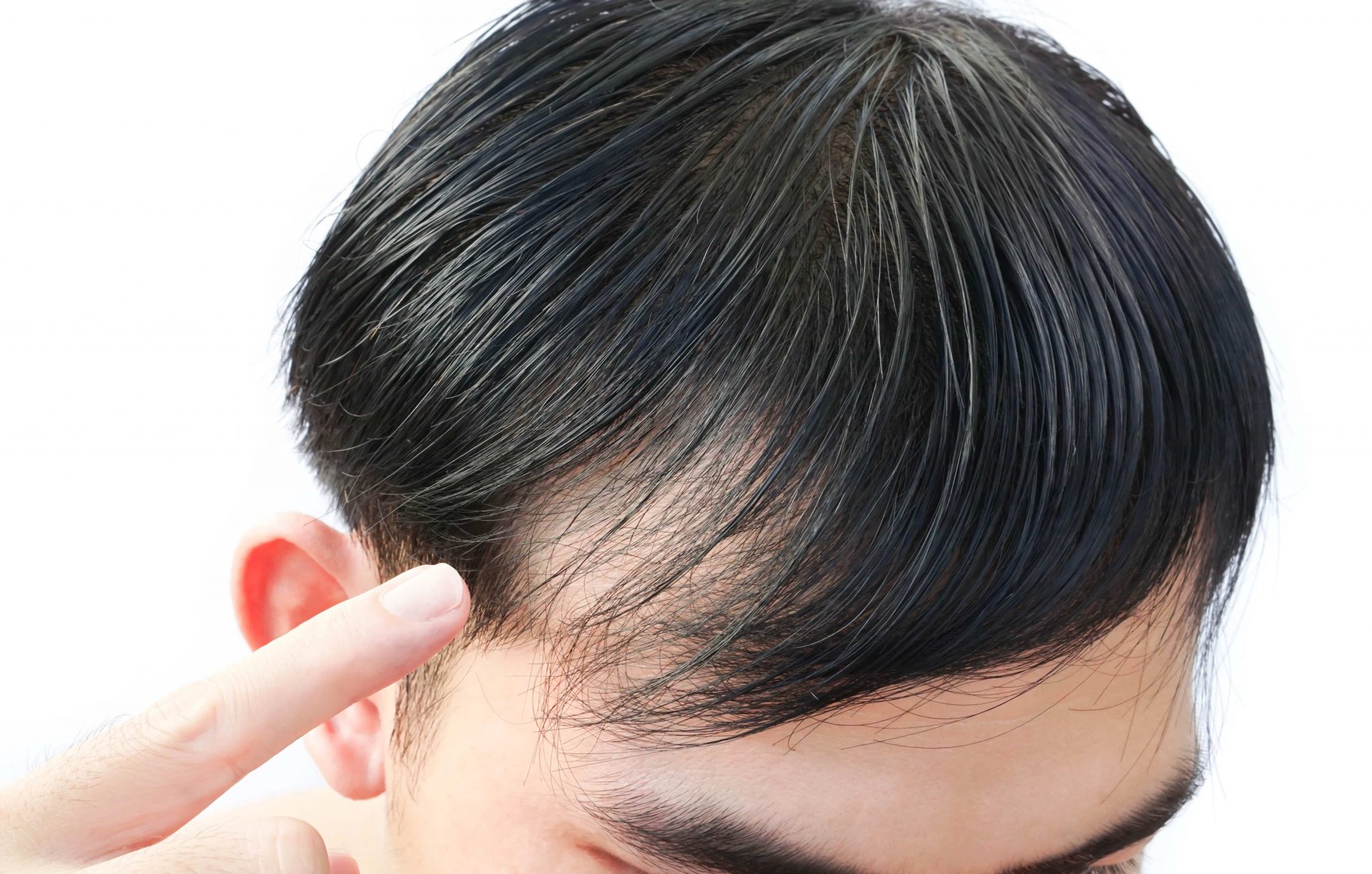 young-man-serious-hair-loss-problem-for-health-car-A2686LX-min-2048x1304.jpg