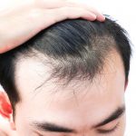 Is it Really Safe to Travel to Turkey for Hair Transplant?