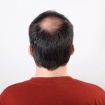 Turkey Hair Transplant Cost 5000 Grafts: Is It Risky?