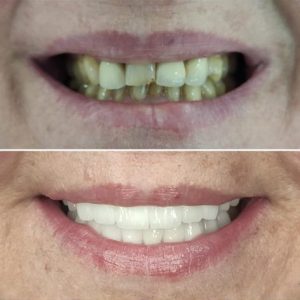 Hollywood Smile CB Bronze Package 6 CB5