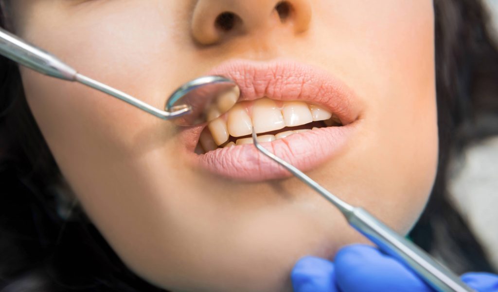 How Much is To Get Dental Bridges in Istanbul?