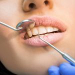 Франција стоматолошки центри- Цени за забни фурнири