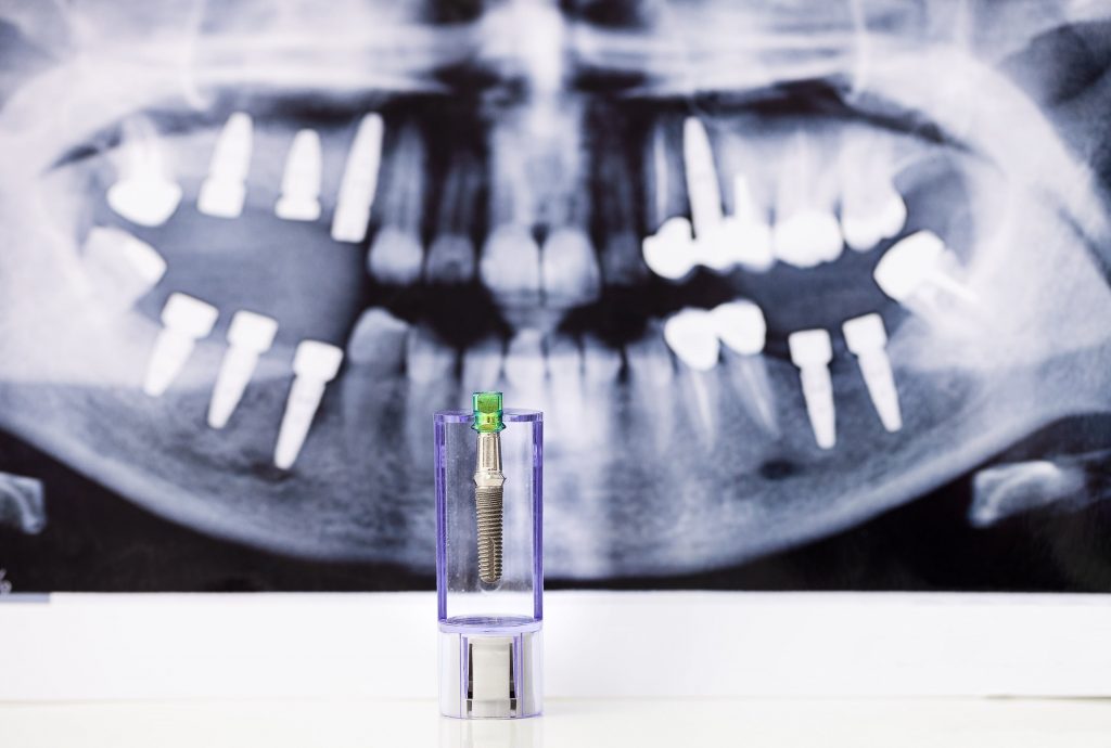 Full Mouth Dental Implants 