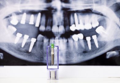 Mitengo ya Kusadasi Dental Implant