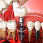 Is It Risky To Have A Dental Implant In Turkey?