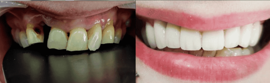 Dental Implants In Turkey