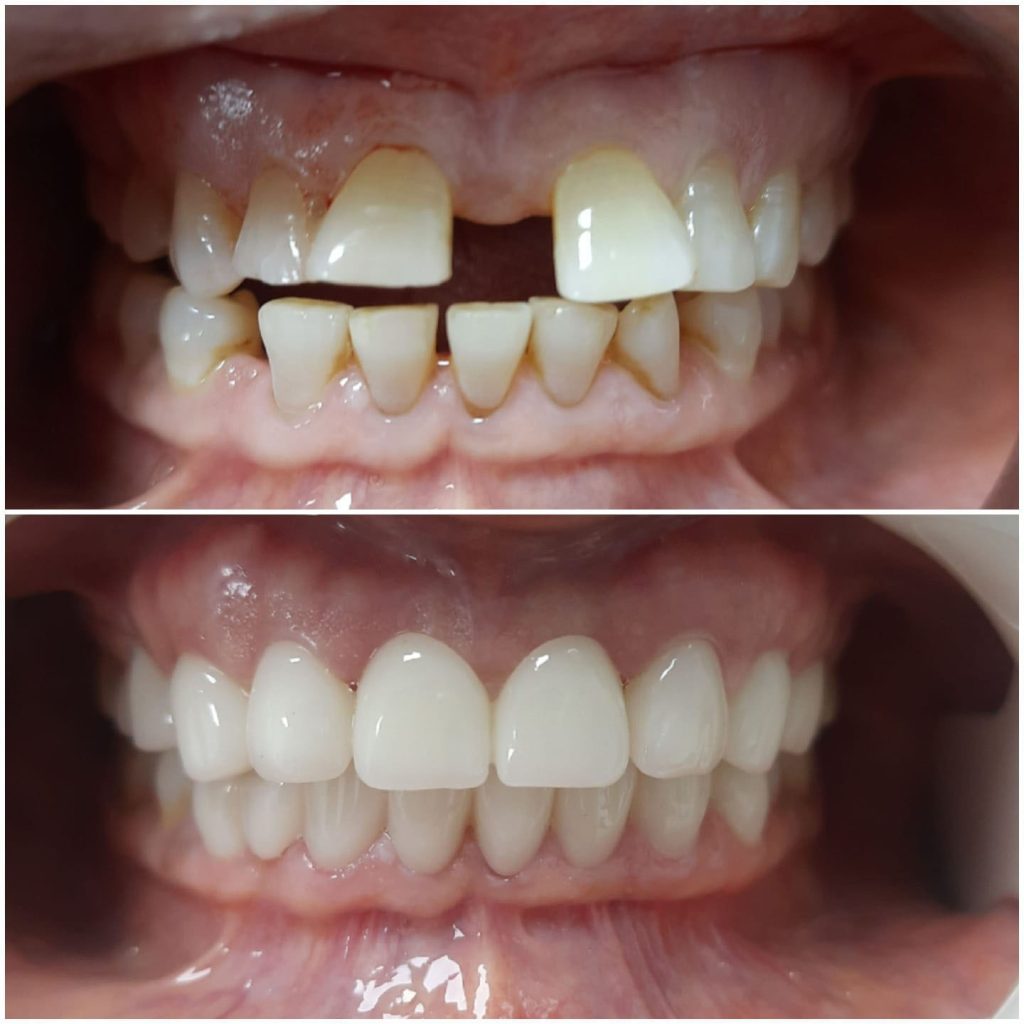 implant dentystyczny