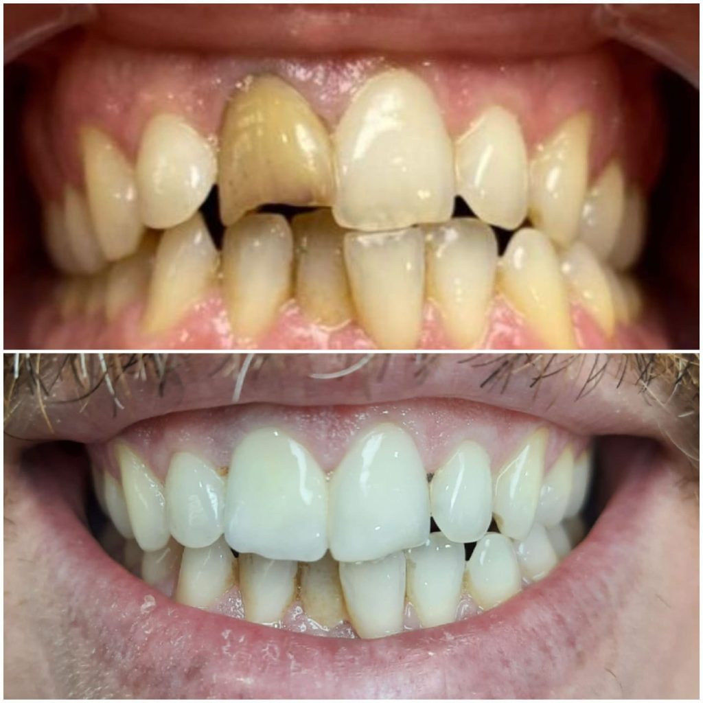 dental veneers