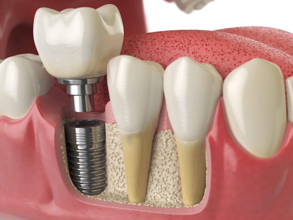 Dental Implant Prices And Tips In Turkey