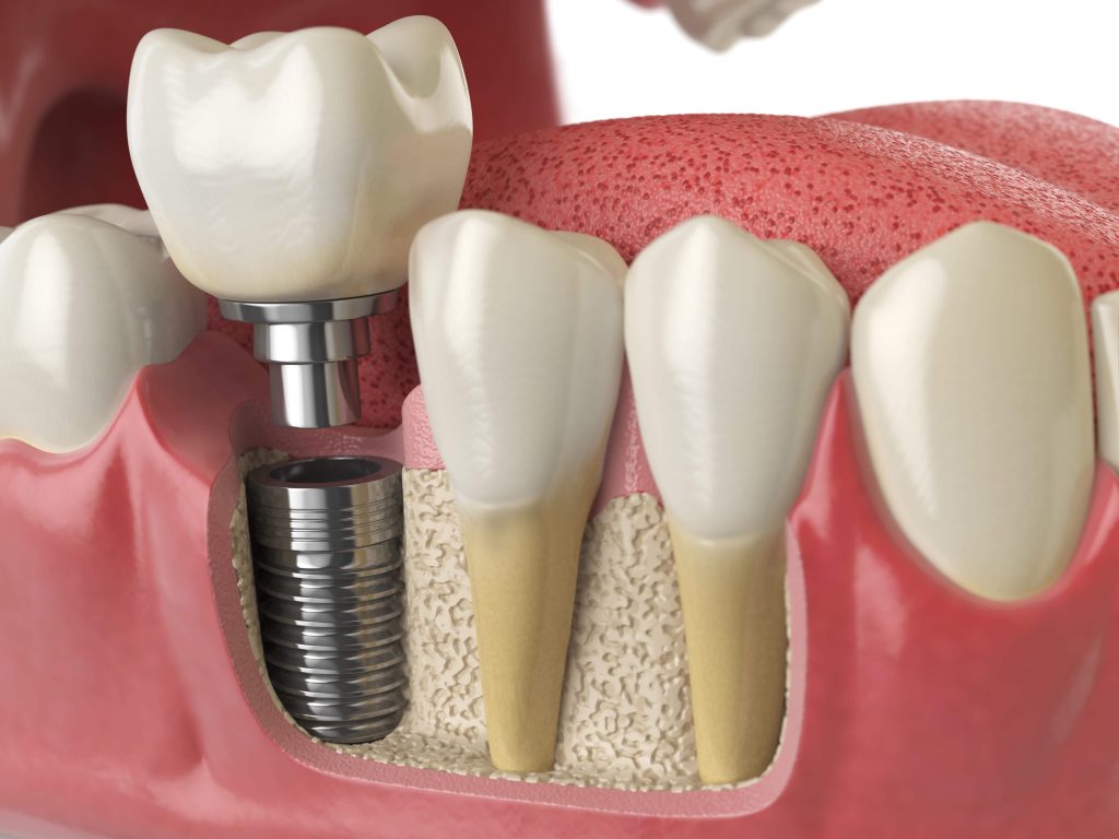 Full Mouth Dental Implants 