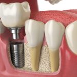 Nobel Biocare Dental Implant Price- Reviews