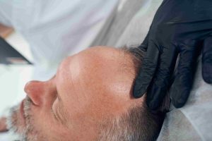 hair transplant in Turkey