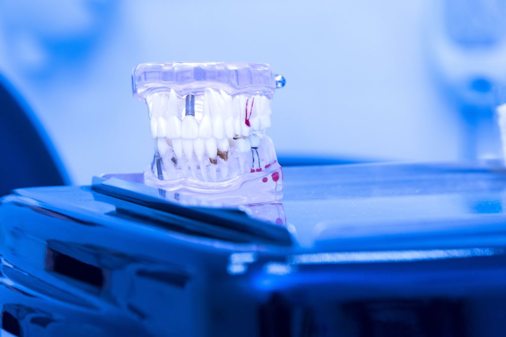 Dental Veneers in Turkey? 2022 Cost And Advantages 3 Dental Ä°mplants