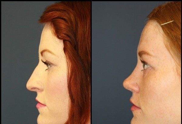 Rhinoplasty (Paghubag sa Ilong) Sa wala pa - Human sa 7