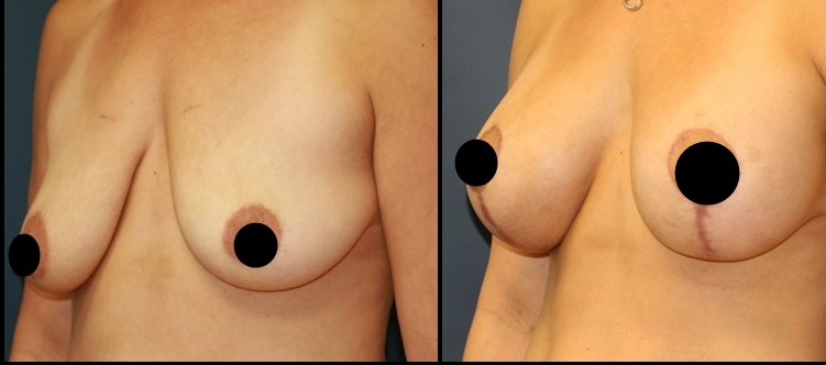 Breast Uplift Before - After 2