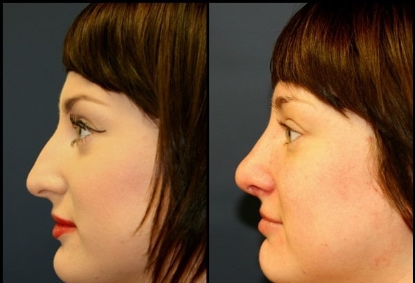 Rhinoplasty (د پوزې دنده) مخکې - 9 وروسته