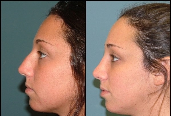 Ринопластика (работа на нос) пред - после 8