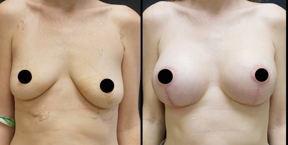 Breast Augmentation Before - After  4