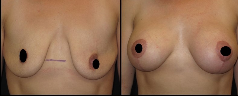 Breast Augmentation Before - After 3