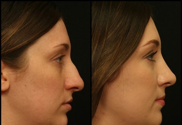 Rhinoplasty (Memutar Hidung) Sebelum - Setelah 6