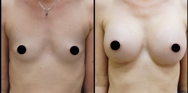 breast augmentation