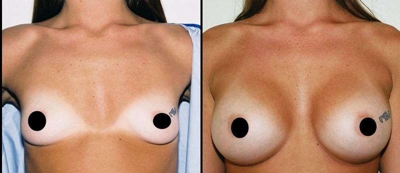 Breast Augmentation Before - After 1