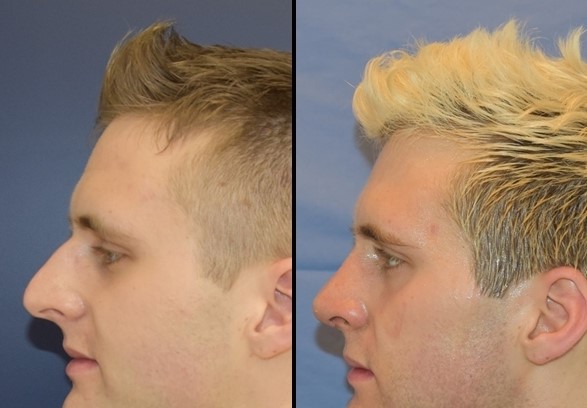 Rhinoplasty (Nose Job) Before - After 3