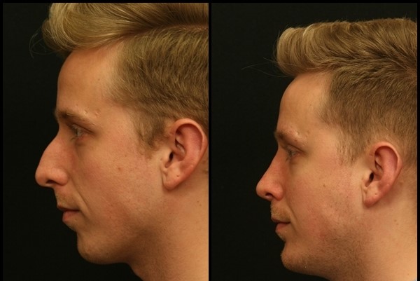 Ринопластика (работа на нос) пред - после 2