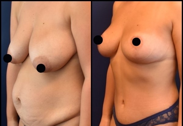  Breast Uplift Before - After 3