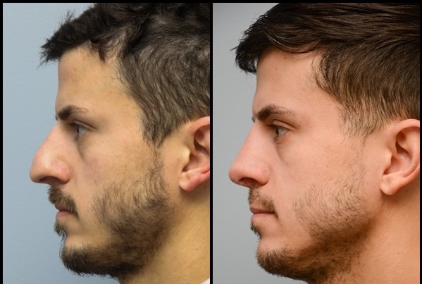 Rhinoplasty (Nose Job) Before - After 1