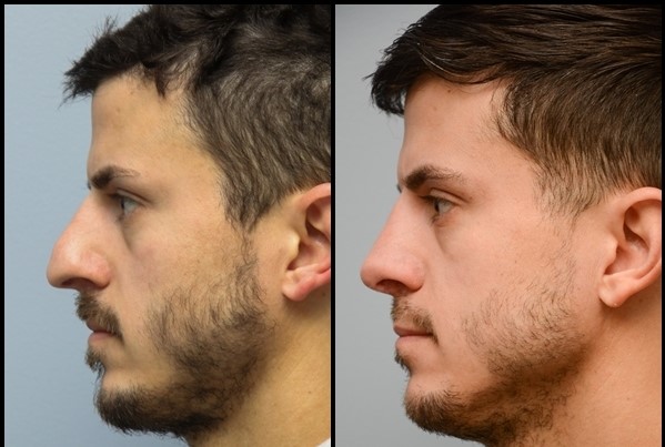 Rhinoplasty (Paghubag sa Ilong) Sa wala pa - Human sa 1