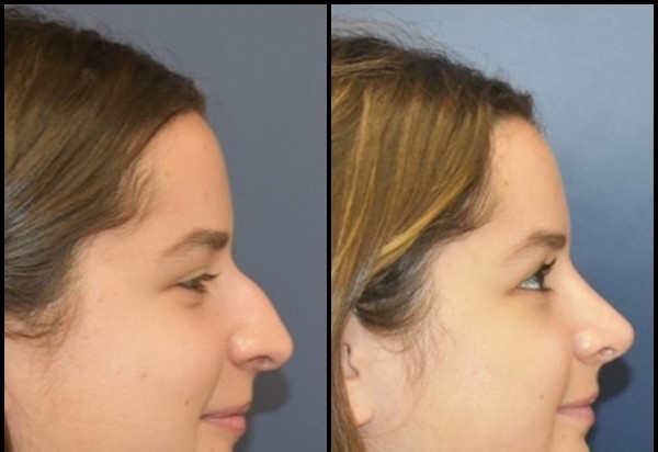 Rhinoplasty (د پوزې دنده) مخکې - 5 وروسته