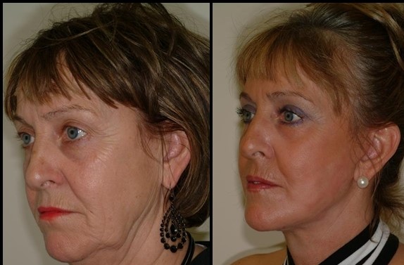  Face Lift Before - After