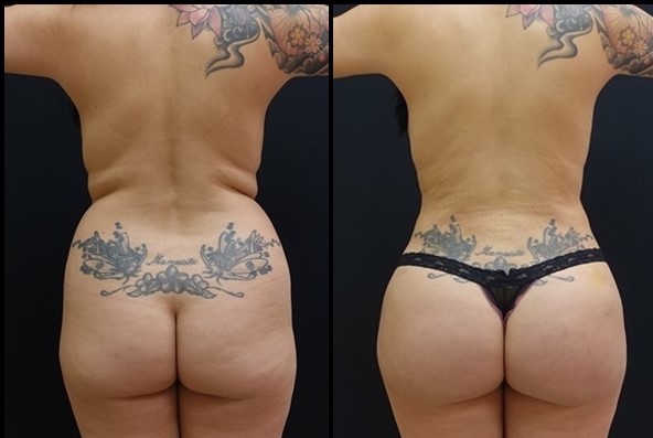 Brazilian Butt Lift Before - After 1