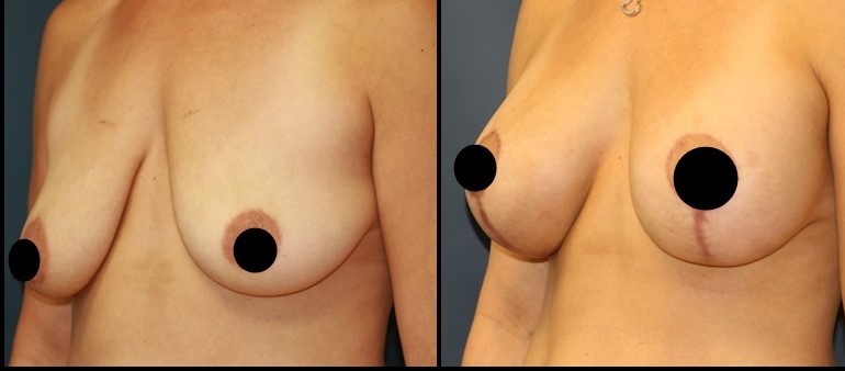 Breast lift surgery