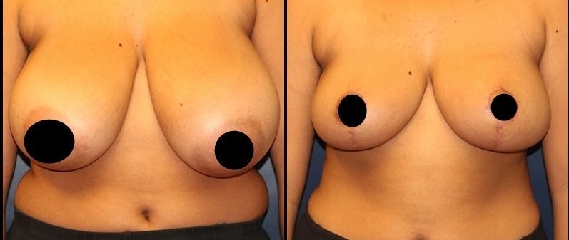 Breast Reduction Before - After 1