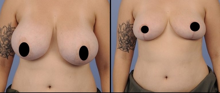  Breast Reduction Before - After 2