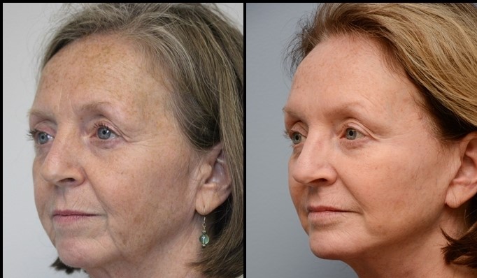  Face Lift Before - After 2