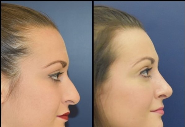 Rhinoplasty (Nose Job) Before - After 4
