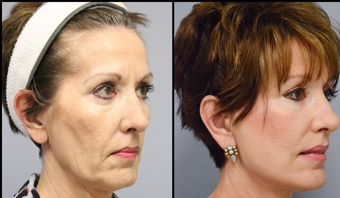  Face Lift Before - After 3