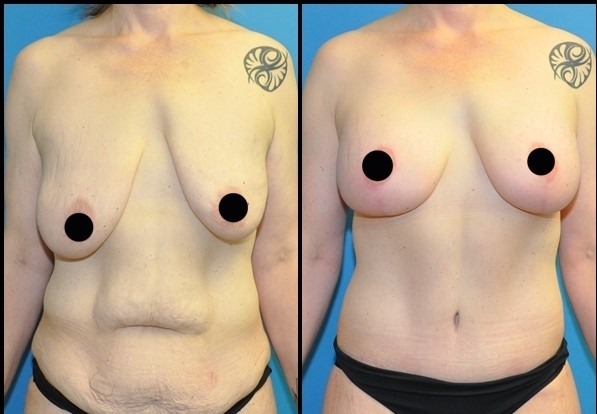  Breast Uplift Before - After 4