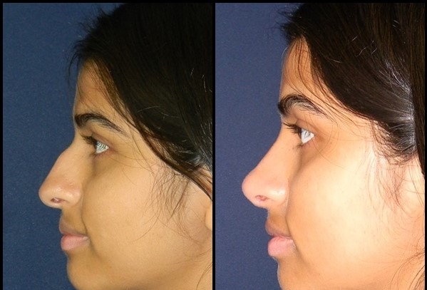 Rhinoplasty