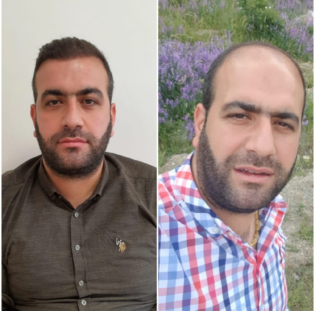 Hair Transplant Before After  9